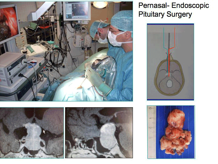 pernasal_endoscopic_pituitary_surgery