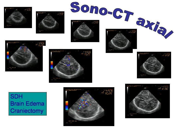 sono-ct