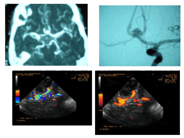 sono_assisted_aneurysm_clipping